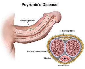 peyroine disease