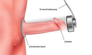 Penis Enlargement Vs Penilie Extenders